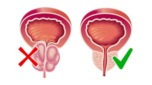 prostaty pred a po použití prostalínu